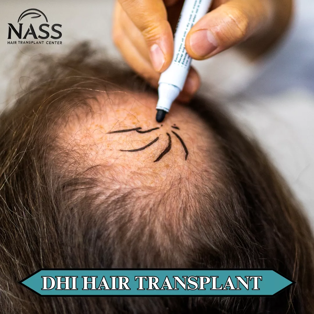 DHI Hair transplant