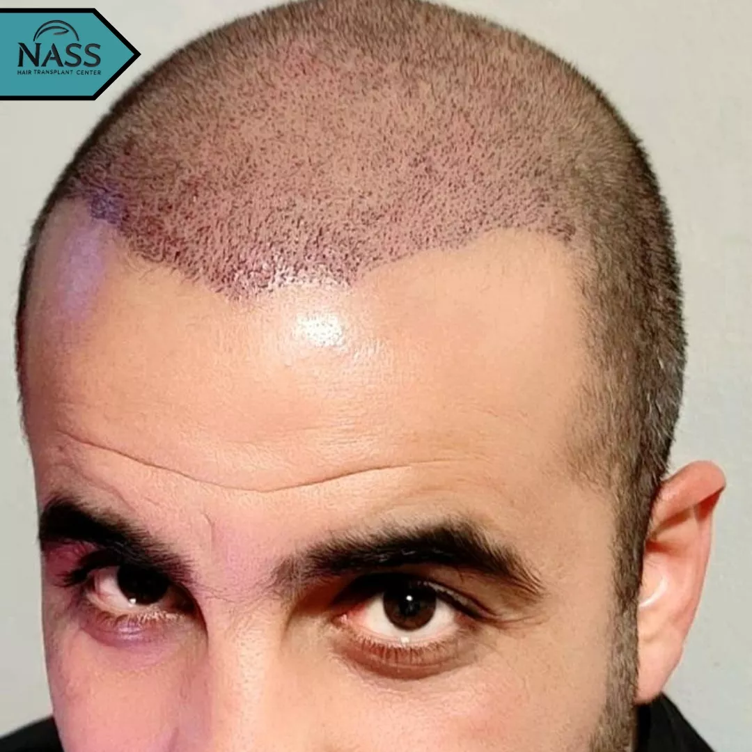 after one month hair transplant
