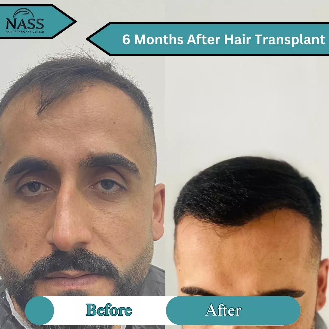 6 months after hair transplant