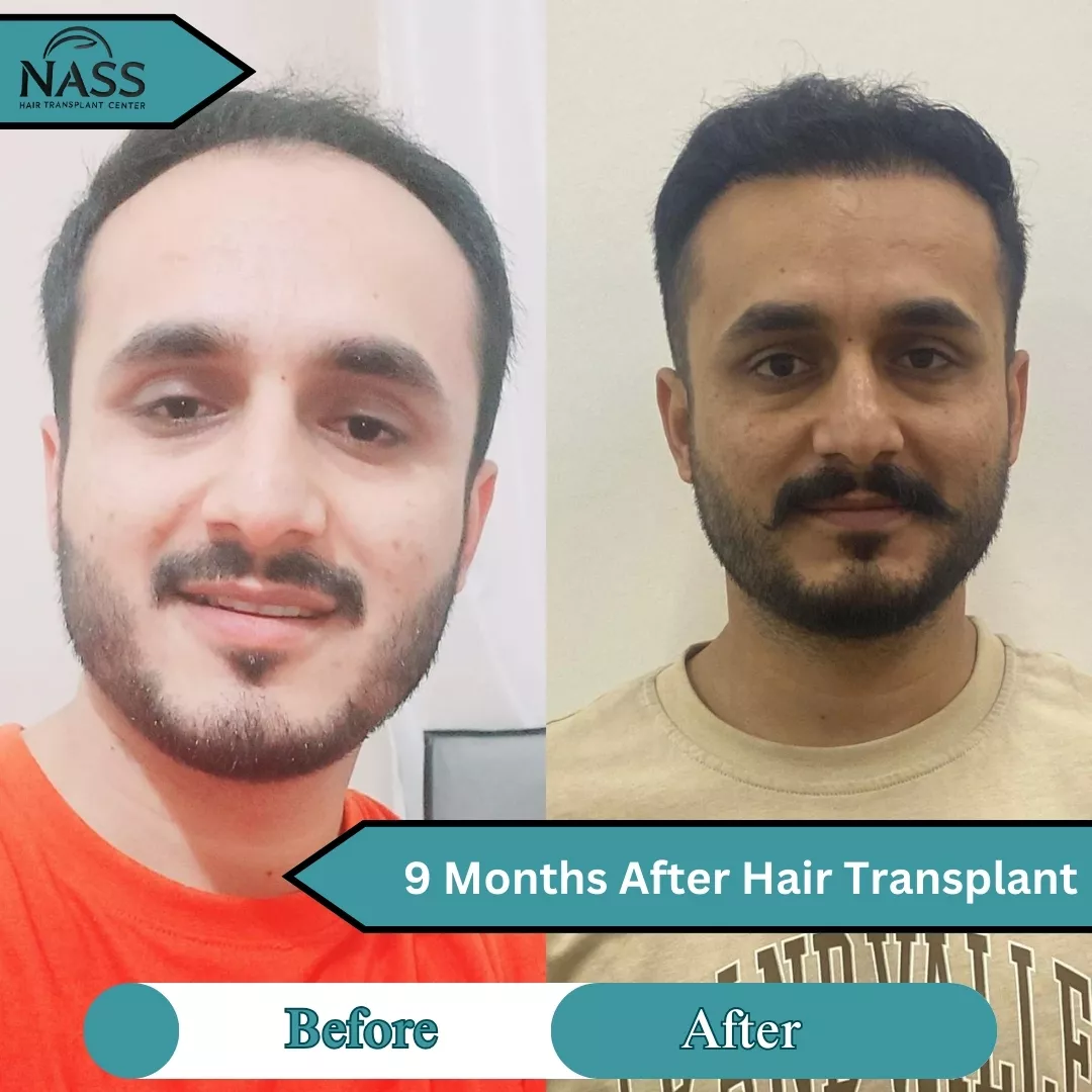 9 months after hair transplant