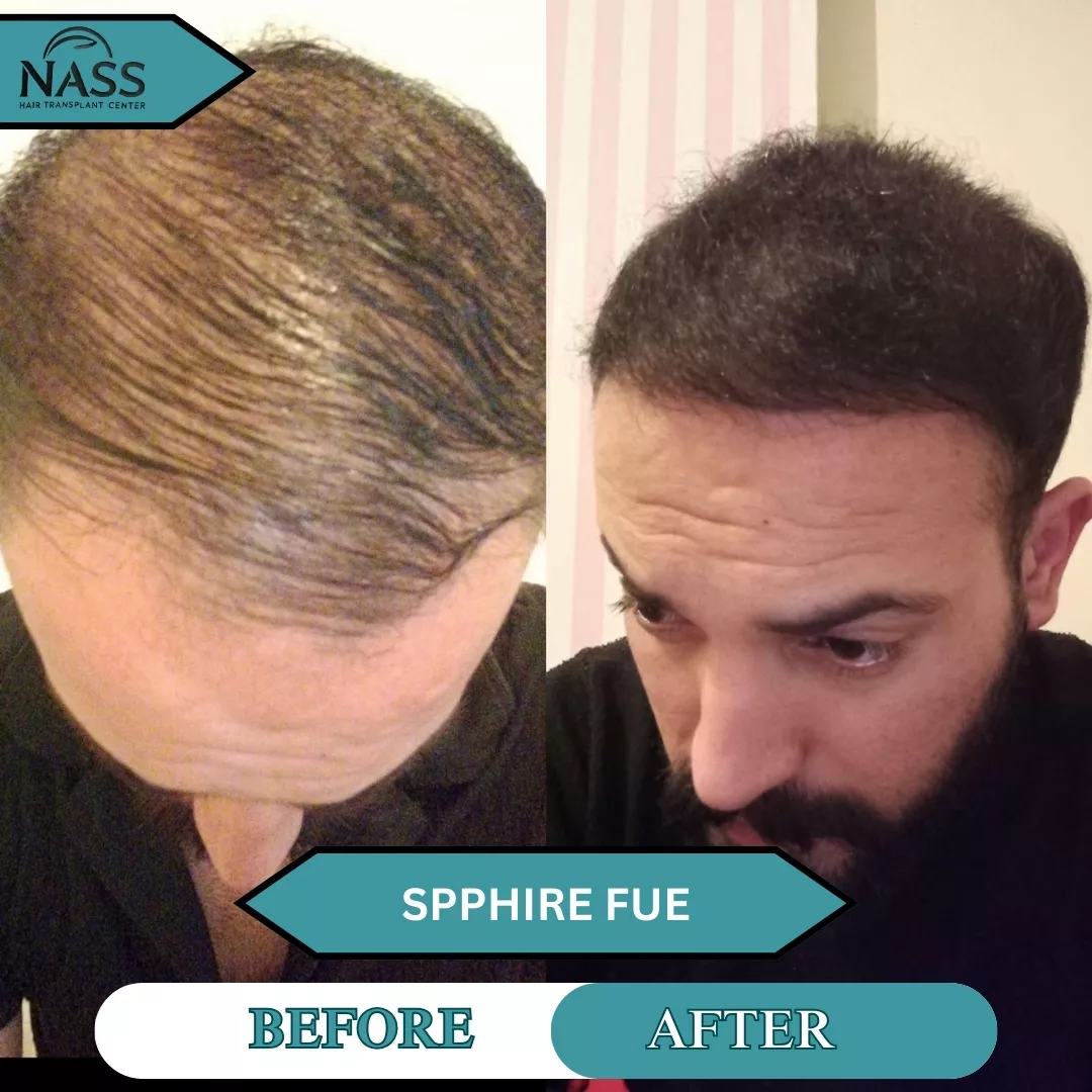 After Hair Transplant