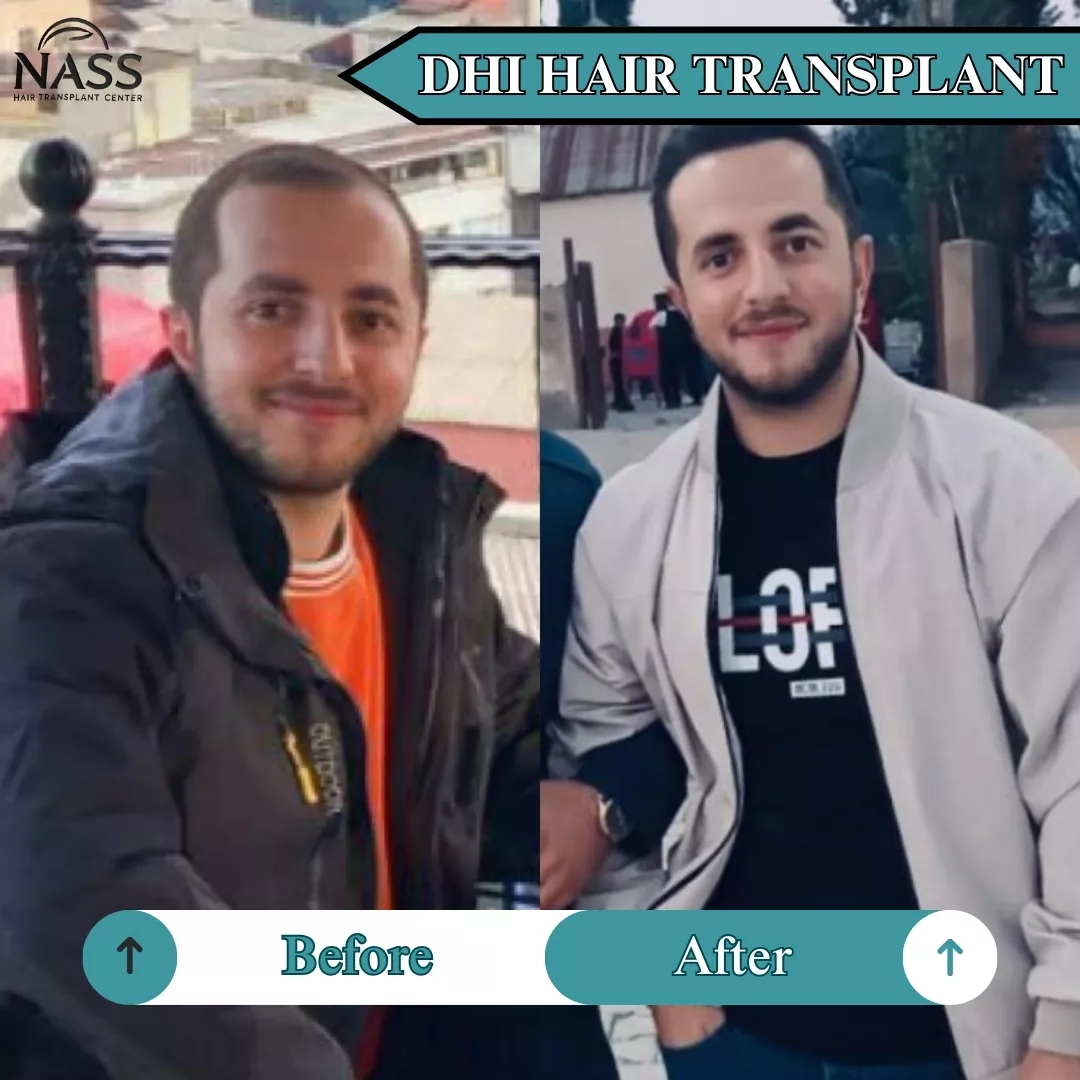 DHI hair restoration