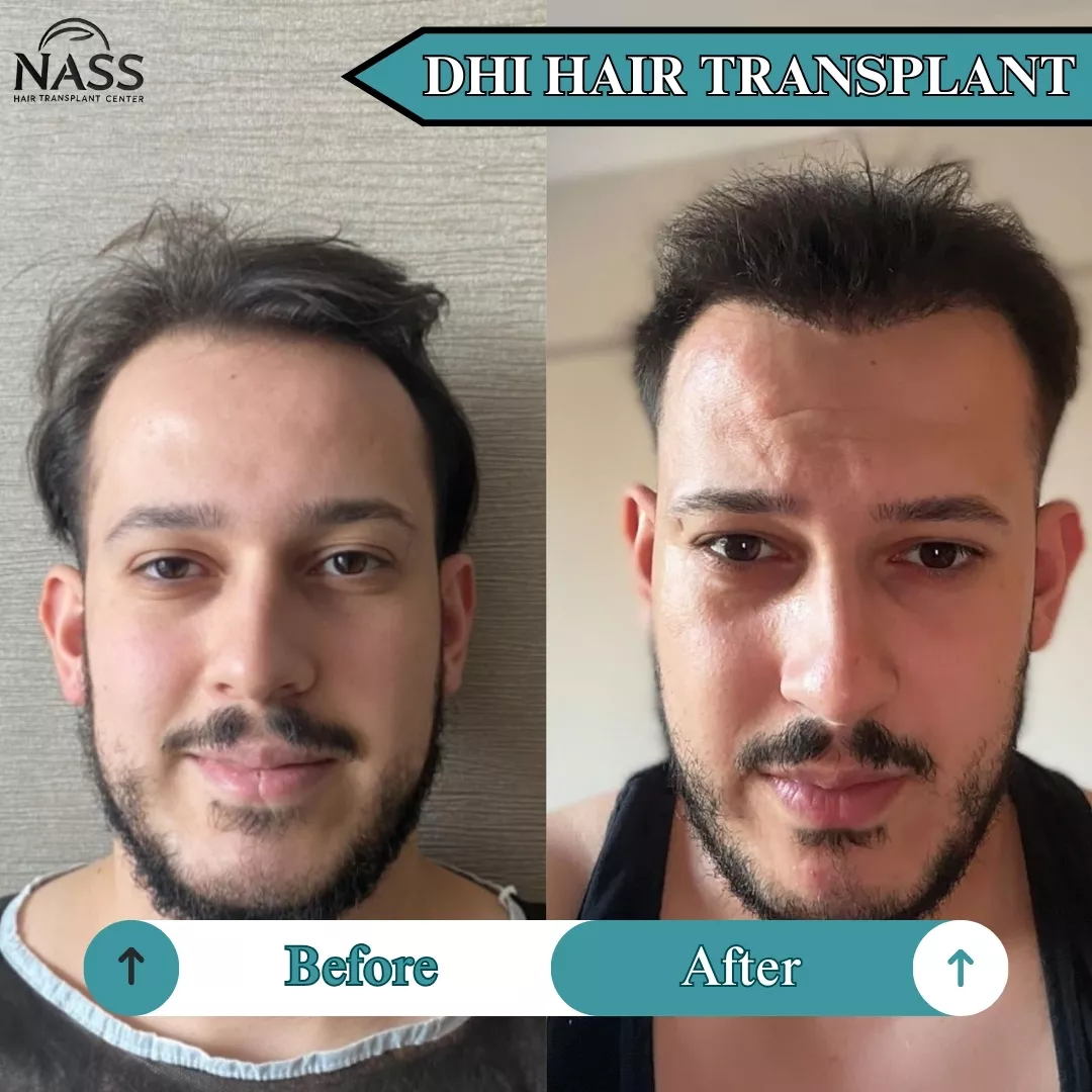 DHI hair transplant Turkey