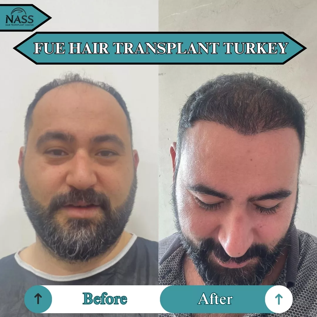 FUE Before After Hair Transplant