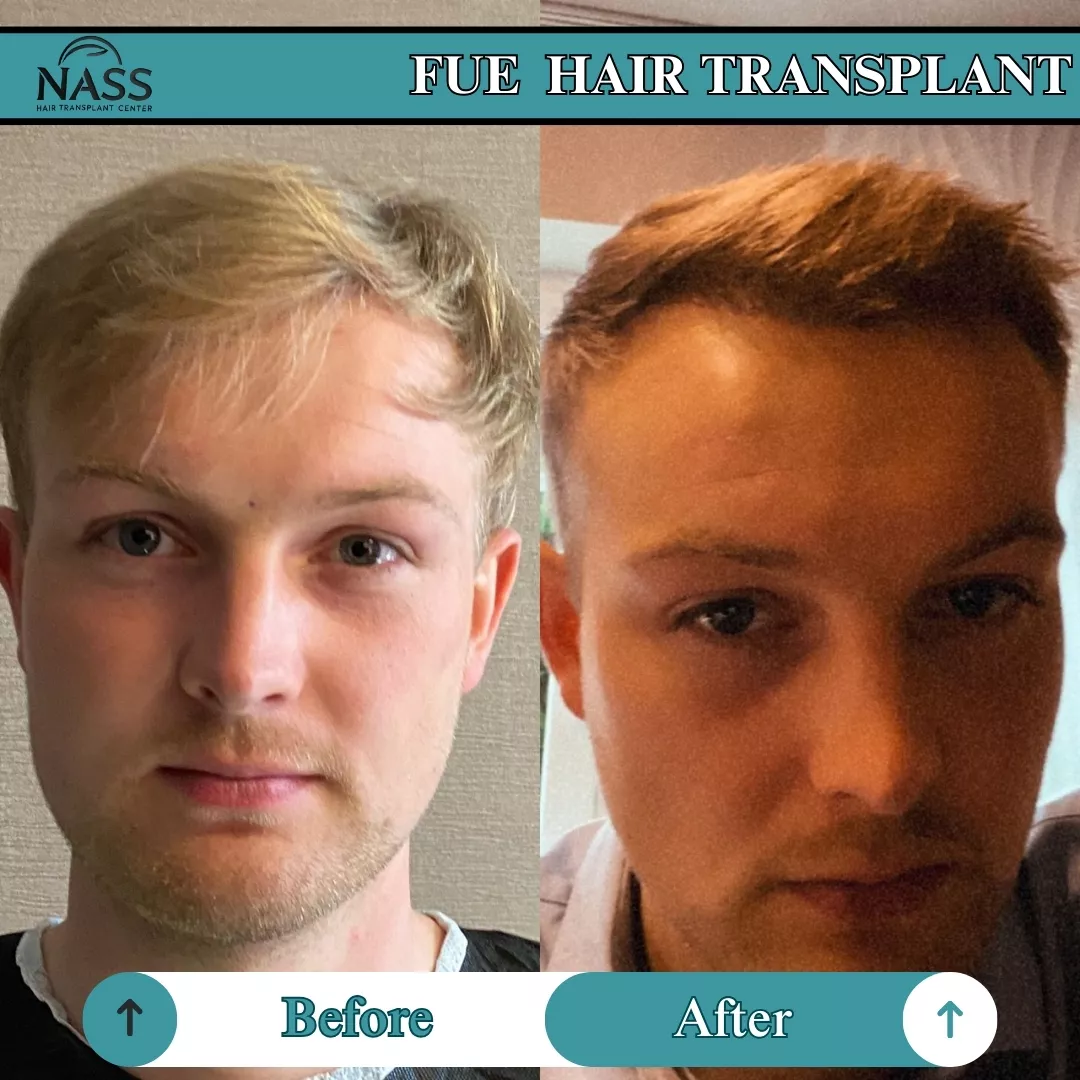 FUE Hair transplant AFTER 6 MONTH