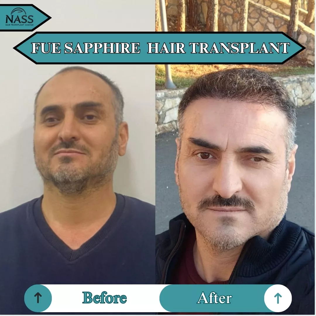 FUE Spphire before after hair transplant