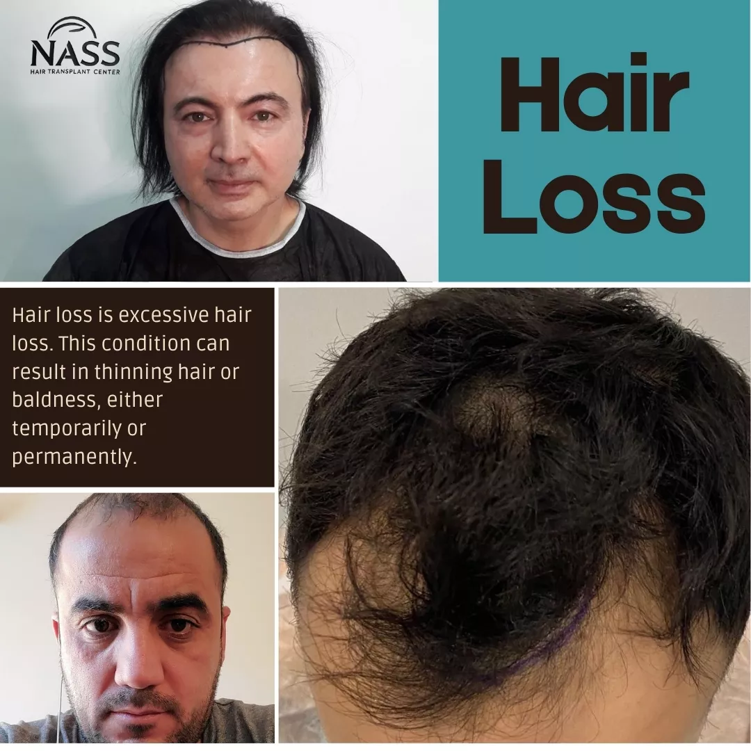 Hair Loss