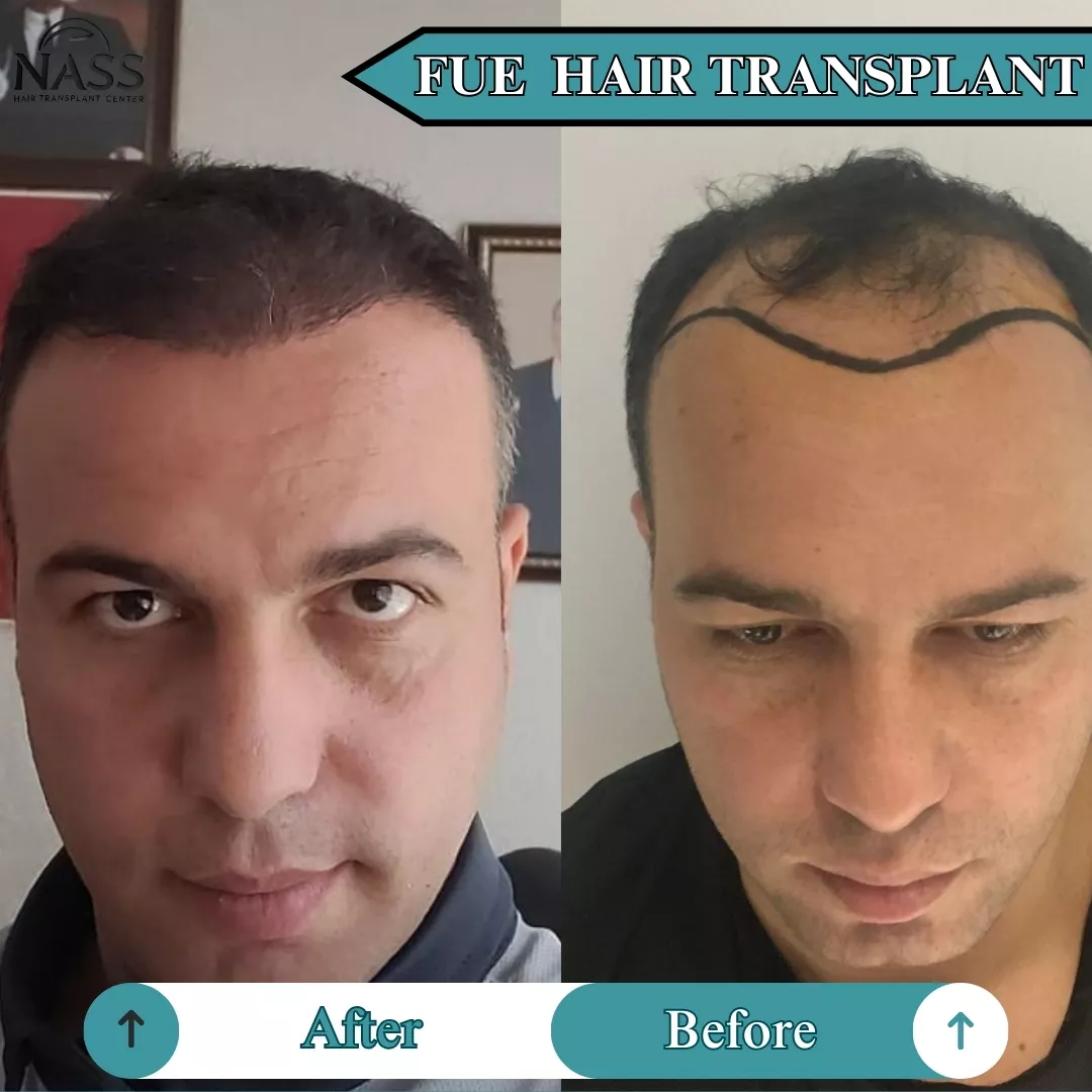 FUE Hair transplant AFTER 6 MONTH