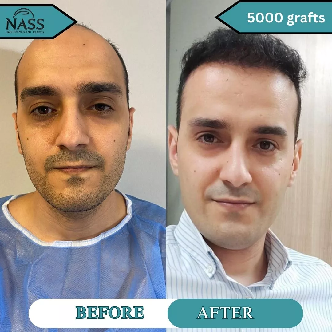 5000 grafts hair transplant