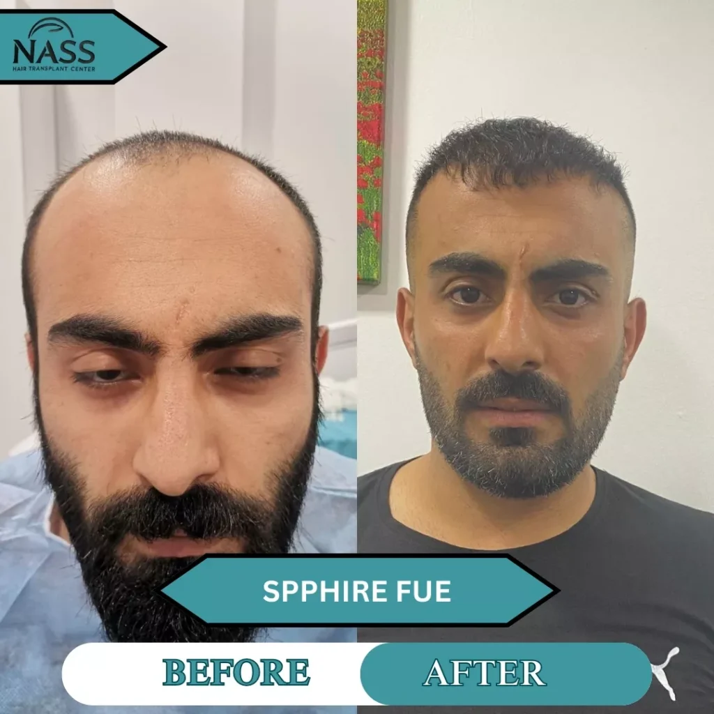 Sapphire FUE hair transplant