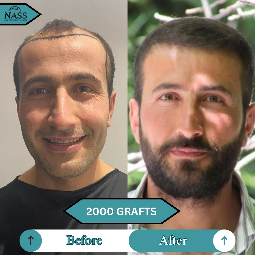 before after 2000 grafts