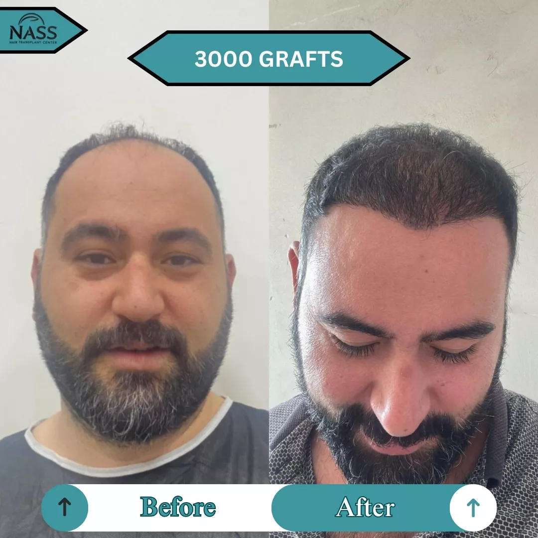 before after 3000 graft