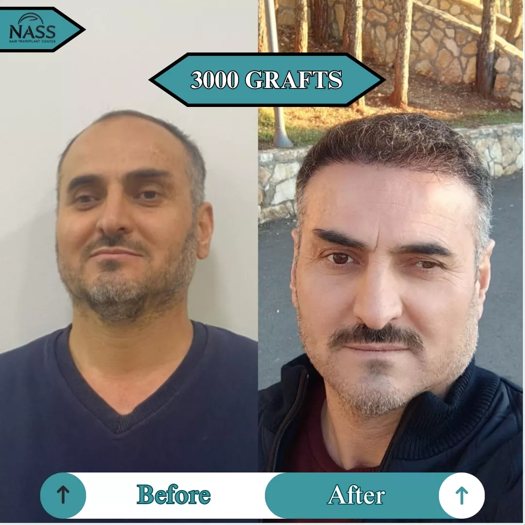 before after 3000 grafts