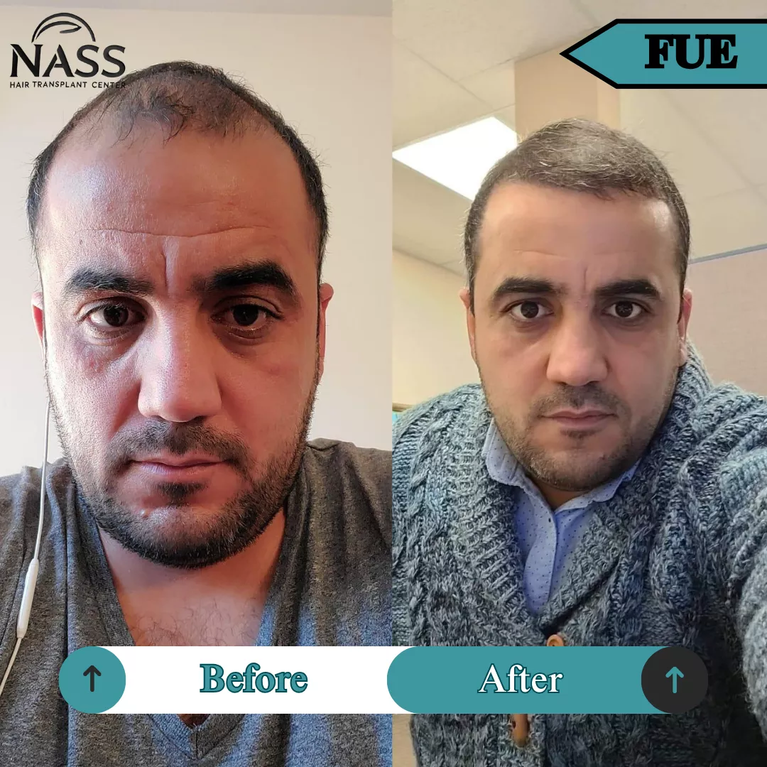 hair transplant turkey