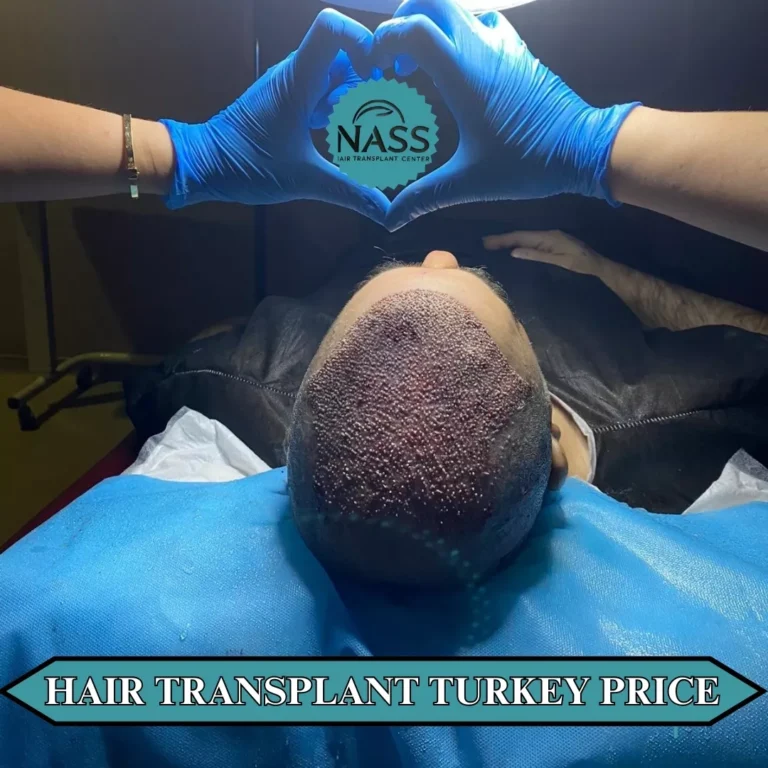 hair transplant turkey price