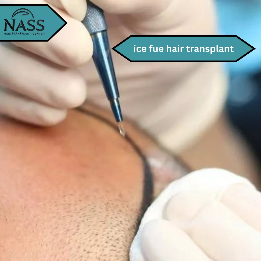 ice fue hair transplant