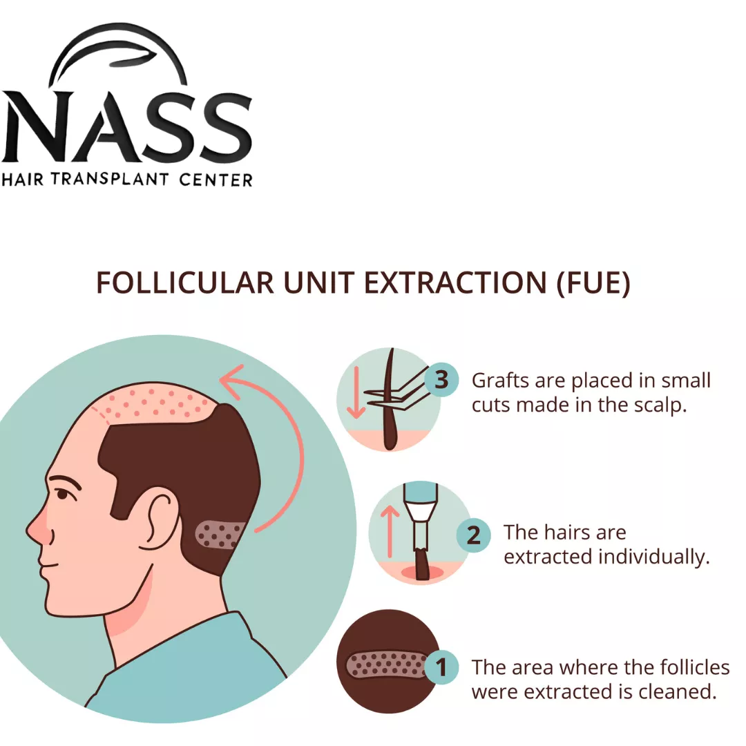 fue hair transplants step